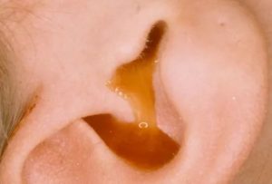 Жидкость в ушах у ребенка лечение