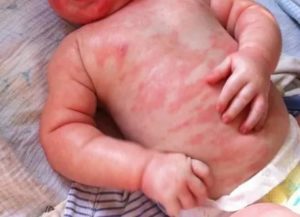 Аллергия у детей до года комаровский