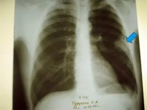 Плевропульмональные спайки в лёгких