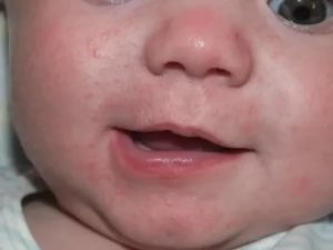 Сыпь возле носа у ребенка