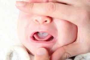 Как убрать молочницу с языка у новорожденных