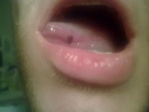 Кровяная шишка на языке