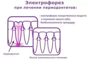 Электрофорез с кальцием для зубов