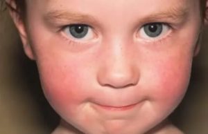 Красные щеки при температуре у ребенка