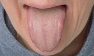 Боль в горле белый налет на языке