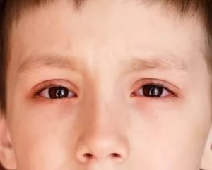 У ребенка болят глаза причины
