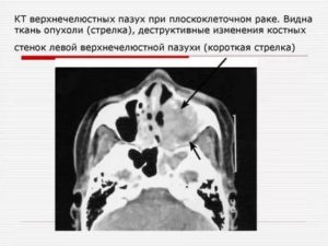 Опухоль в пазухе носа