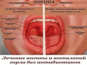 Почему не проходит ангина после антибиотиков