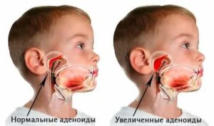 Аллергический аденоидит у детей симптомы