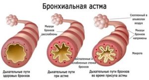 Может ли бронхит перейти в астму