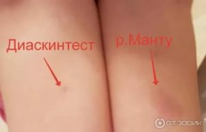 Диаскинтест можно ли делать при простуде