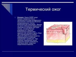 Ожог слизистой рта спиртом лечение