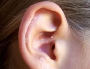 Корочки в ушах у человека лечение