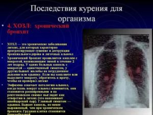 Можно ли курить после пневмонии