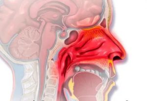 Воспаление слизистой оболочки носа лечение