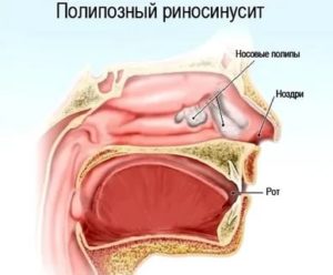 Полипозный риносинусит лечение народными средствами