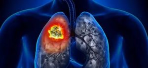 Можно ли курить при пневмонии легких