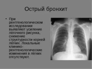 Рентгенологические признаки бронхита