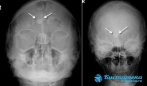 Киста в лобной пазухе симптомы
