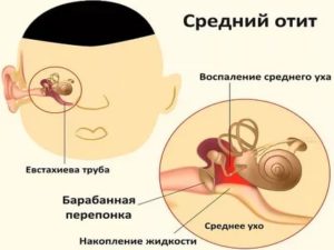 Жидкость в ушах у ребенка лечение
