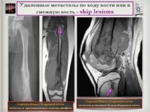 Если метастазы пошли в кости сколько живут