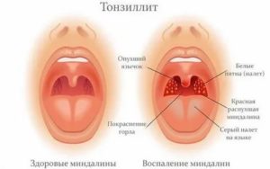 Полная декомпенсация миндалин что это