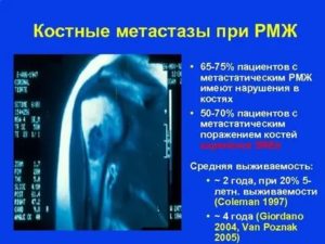 Если метастазы пошли в кости сколько живут