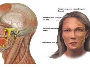 Онемение уха и части головы