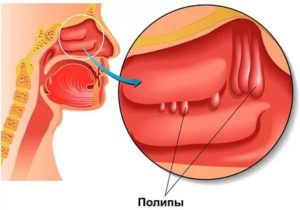 Полипозный риносинусит лечение народными средствами