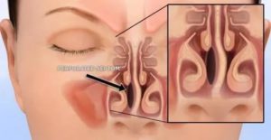 Гиперплазия слизистой носовых ходов