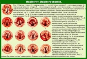 Можно ли гулять при ларинготрахеите