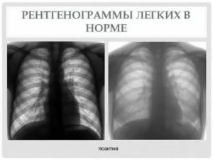 Рентгенограмма легких в норме