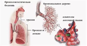 Симптомы заболевания легких и бронхов