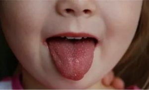 Сыпь на языке у ребенка фото