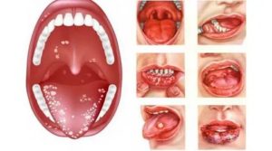 Боль под языком при глотании