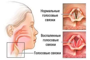Болезни голосовых связок симптомы лечение