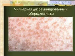 Туберкулез кожи симптомы первые признаки фото