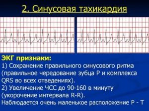 Тахикардия при температуре