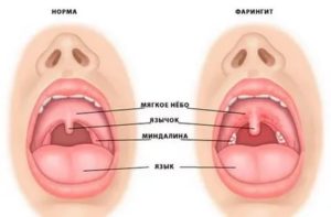 К какому врачу идти с ангиной