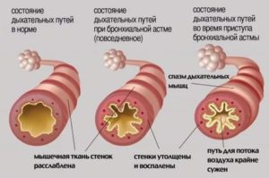 Спазм дыхательных путей причины