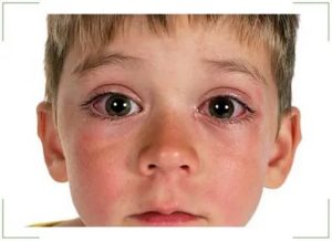 Красные глаза у ребенка при простуде