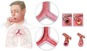 Отек бронхов симптомы и лечение