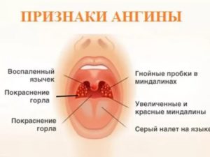 Почему не проходит ангина после антибиотиков