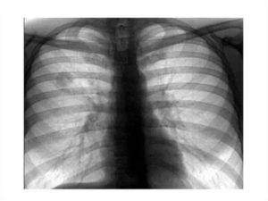 Туберкулёма лёгких заразна или нет