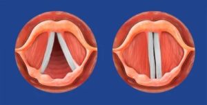 Несмыкание голосовых связок лечение