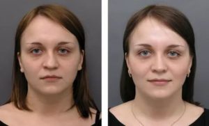 Как выпрямить нос без операции