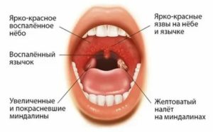 Как отличить мононуклеоз от ангины