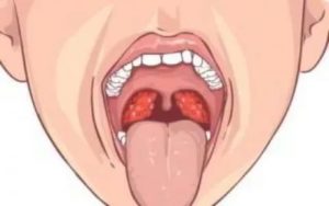 Кровоподтеки в горле
