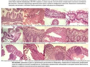 Лимфоидные фолликулы в кишечнике