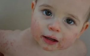 Пищевая аллергия у ребенка комаровский